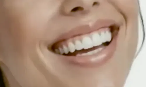 Sorriso do paciente antes do tratamento